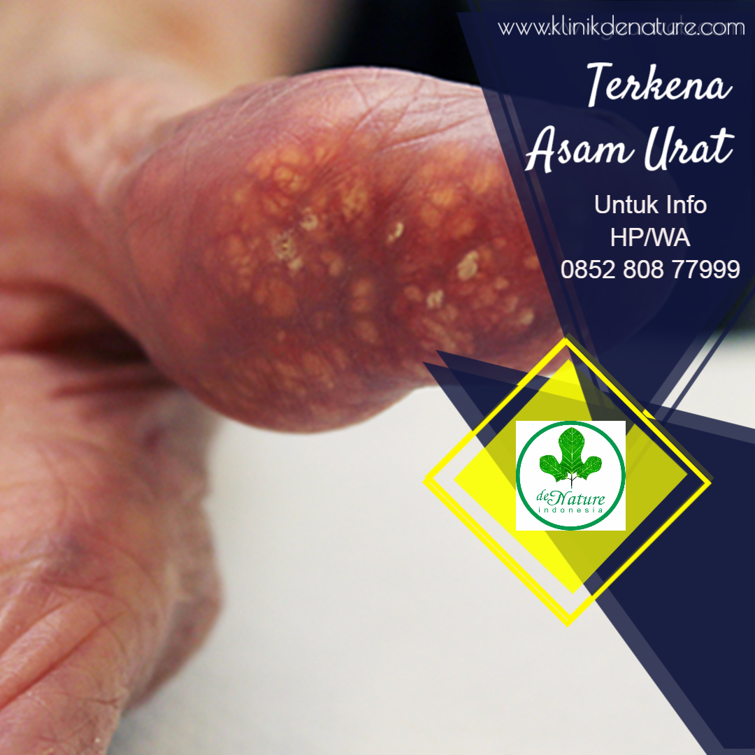 Obat Asam Urat Alami Obat Asam Urat